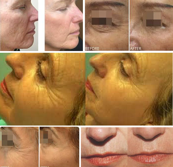 Skin Classification Scale - YouBeauty.com